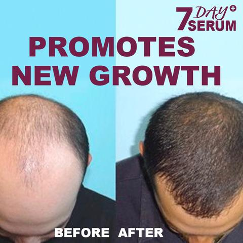 7 Days Plus Hair Growth Serum - Buy 1 Get 1 Free